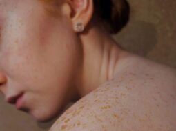 Skin Cancer