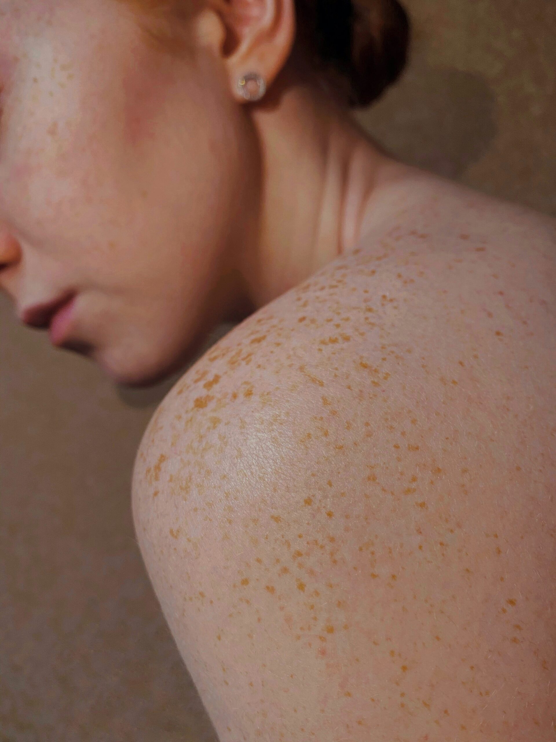 Skin Cancer