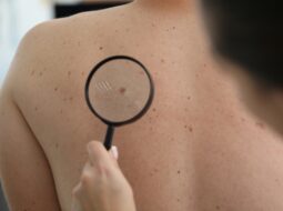 Skin Cancer