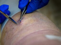 Faisal Qidwai - Skin Cancer
