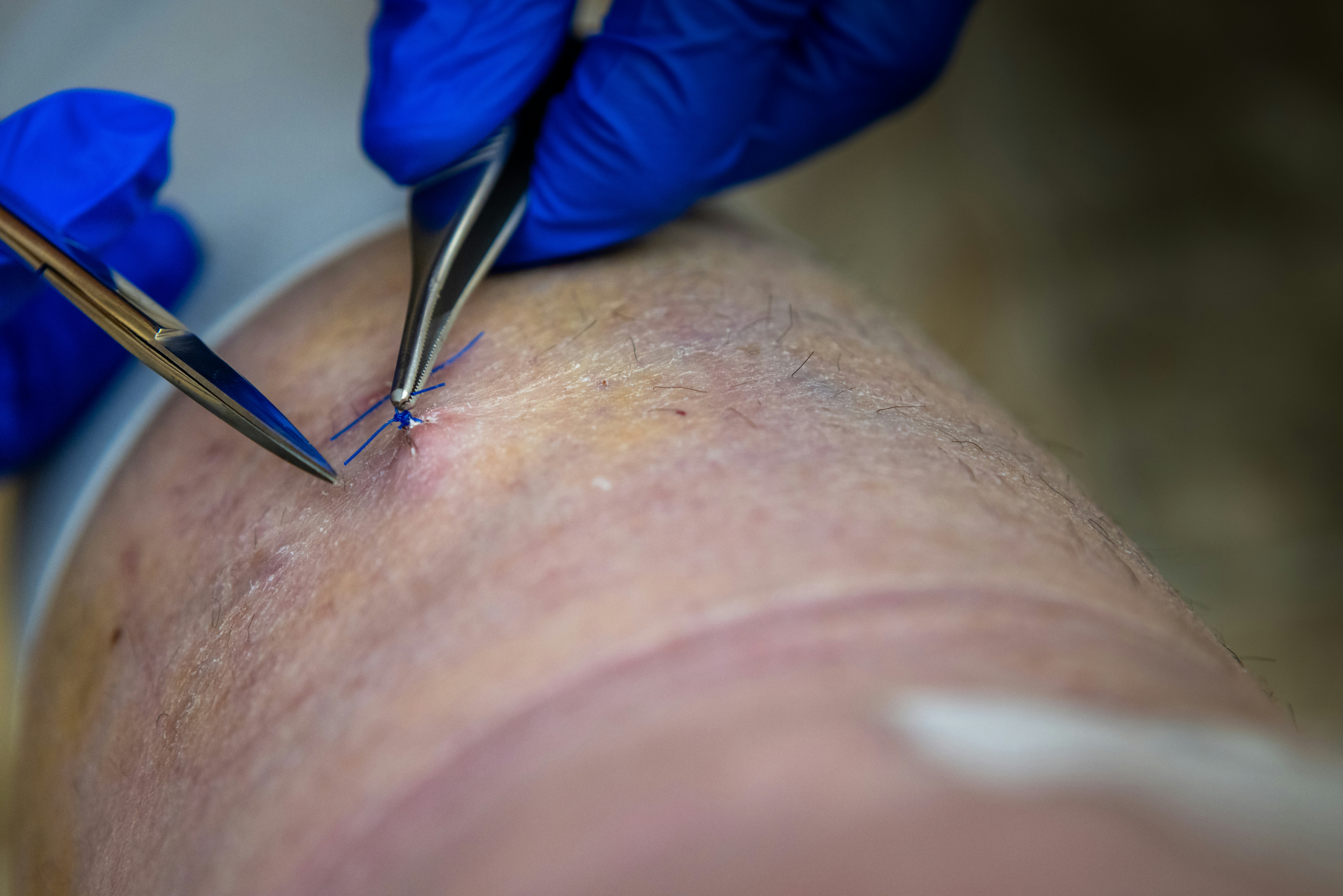 Faisal Qidwai - Skin Cancer